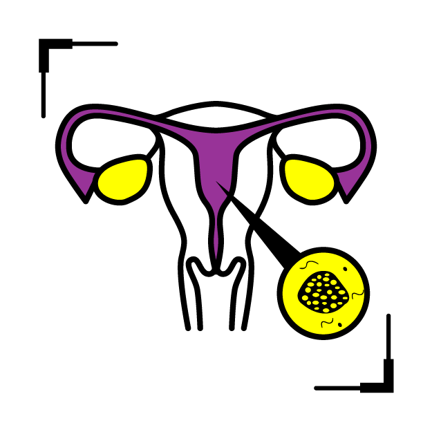 Graphic icon of a uterus annotated with cervical neck cancer location