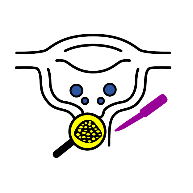 Graphic icon of a uterus having cancer test