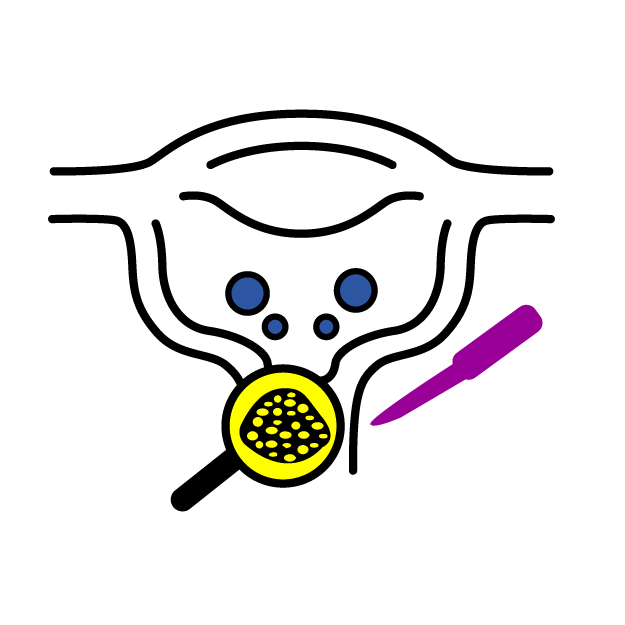 Graphic icon of a uterus having cancer test