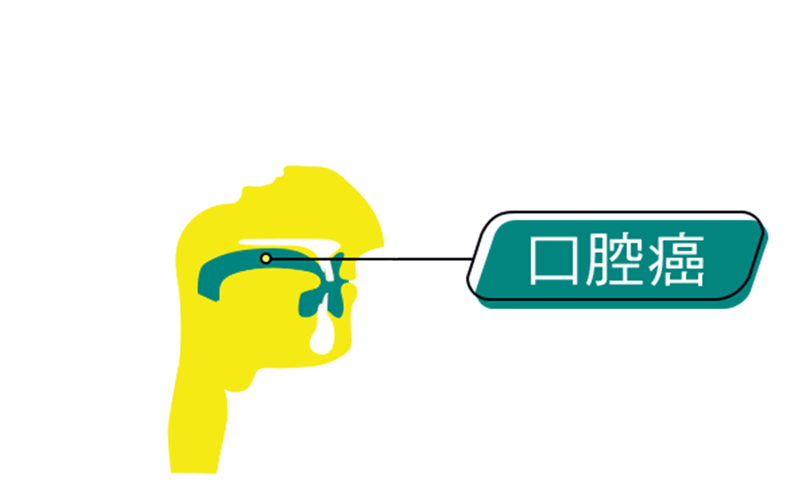 An graphic representation of the intersection of human head, annotated with location of Oral Cancer