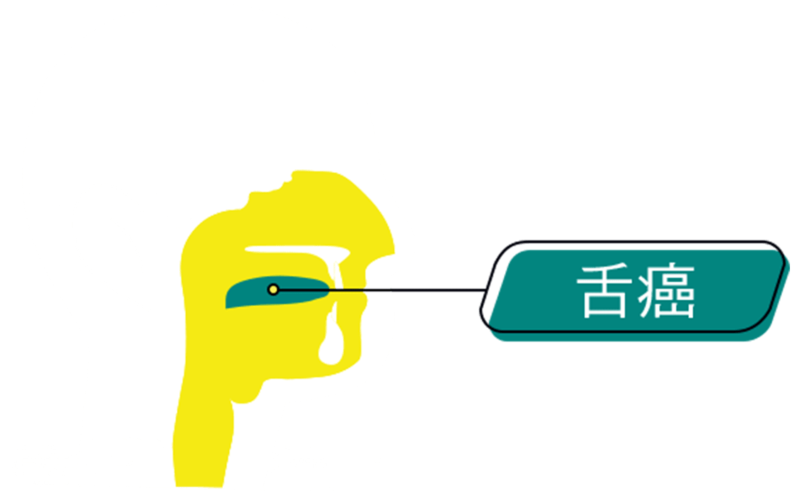 An graphic representation of the intersection of human head, annotated with location of Tongue Cancer