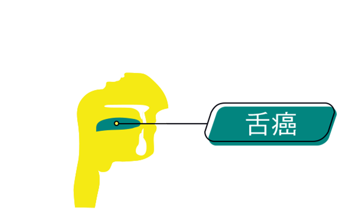 An graphic representation of the intersection of human head, annotated with location of Tongue Cancer