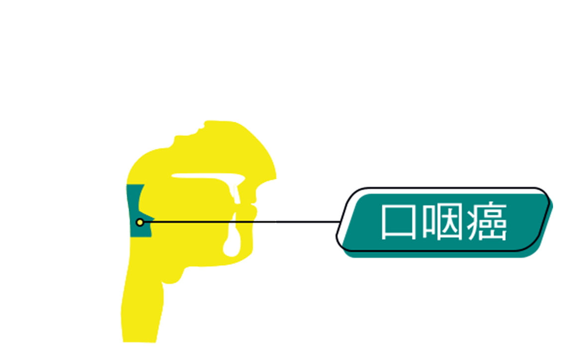 An graphic representation of the intersection of human head, annotated with location of Oropharyngeal Cancer