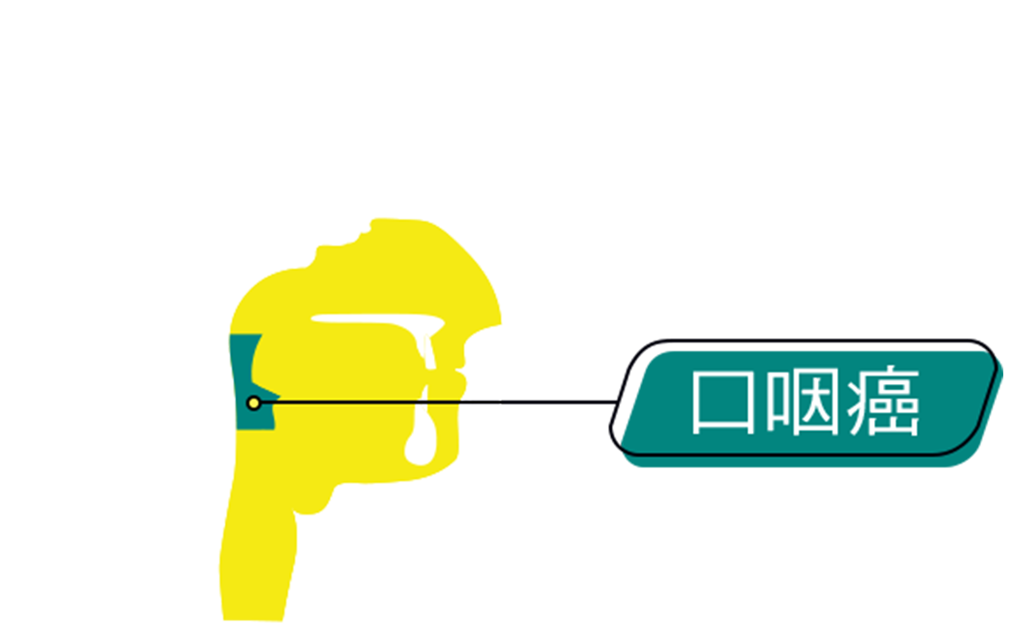 An graphic representation of the intersection of human head, annotated with location of Oropharyngeal Cancer