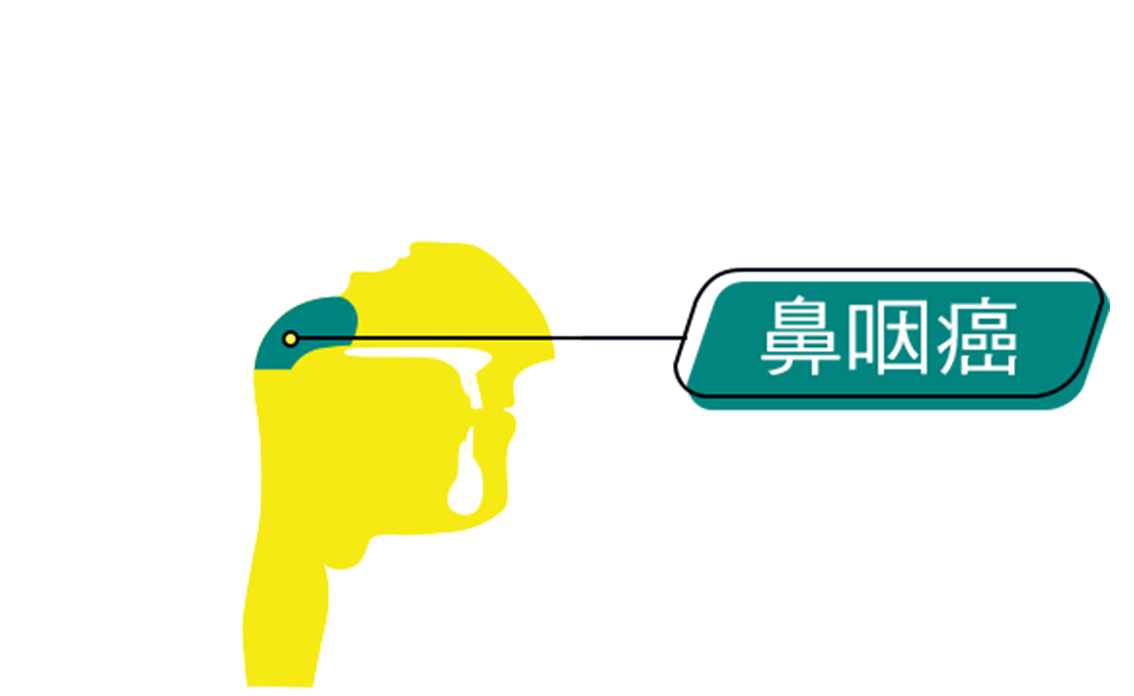 An graphic representation of the intersection of human head, annotated with location of Nasopharyngeal carcinoma