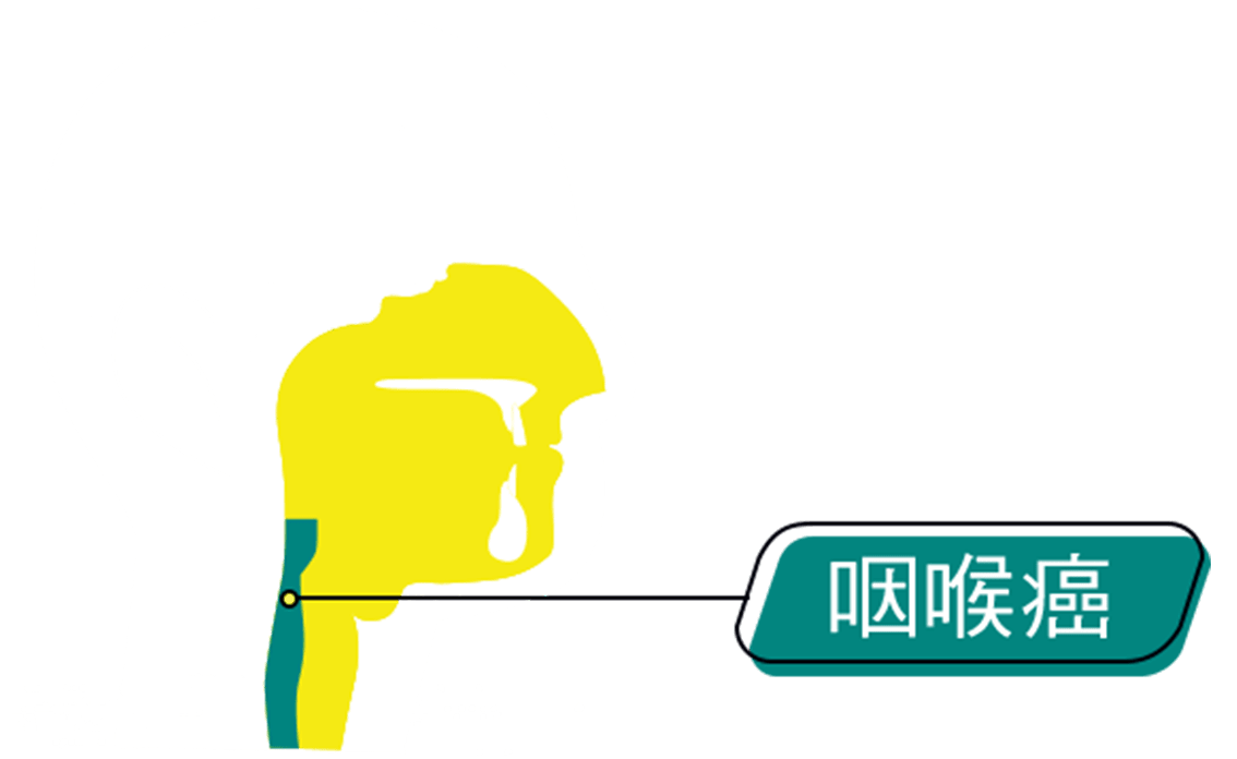 An graphic representation of the intersection of human head, annotated with location of Laryngeal cancer