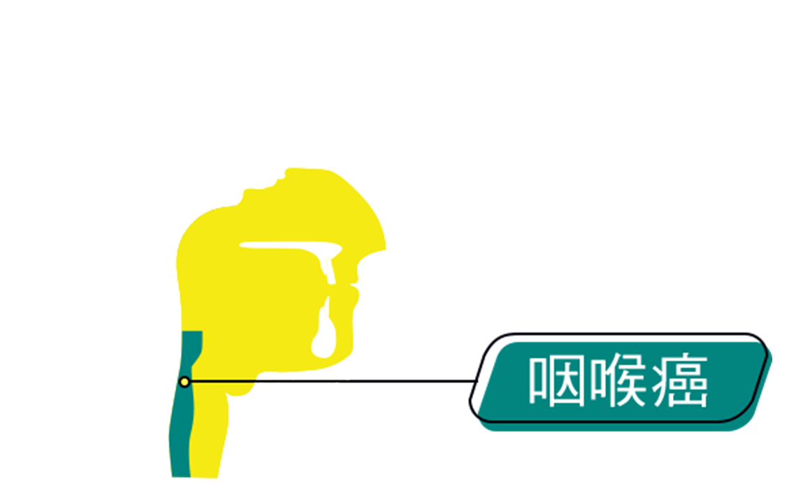 An graphic representation of the intersection of human head, annotated with location of Laryngeal cancer
